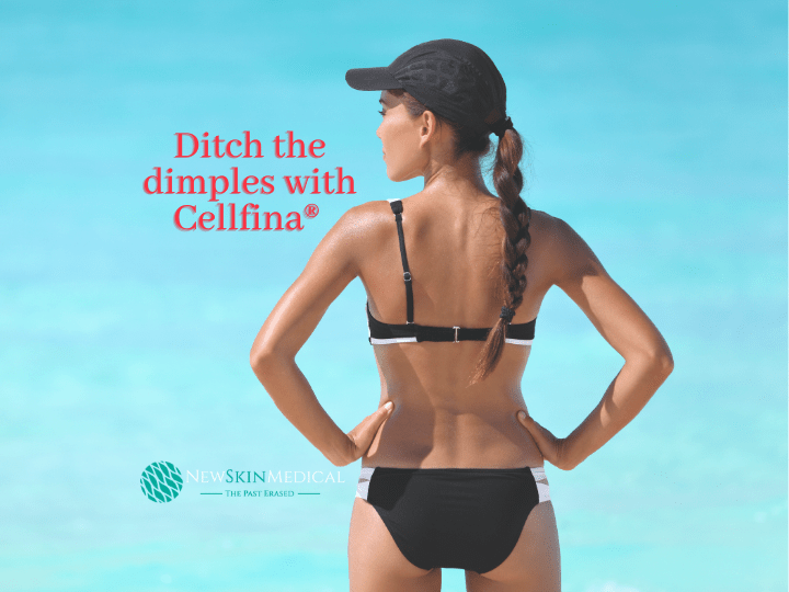 Cellfina Cellulite Treatment 