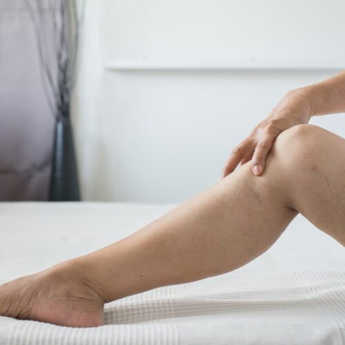 Therapeutic and Cosmetic Vein Care at Vein Specialists of Augusta includes Spider vein treatment and Varicose vein treatment options