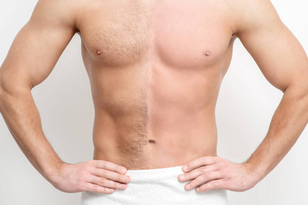 New Skin Medical now offers Motus Ax Laser Hair Removal - available for men and women desiring a pain-free laser hair removal treatment