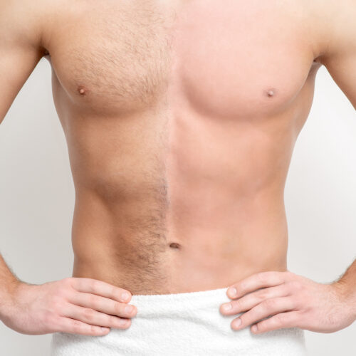 New Skin Medical now offers Laser Hair Removal to men and women desiring a pain-free laser hair removal treatment