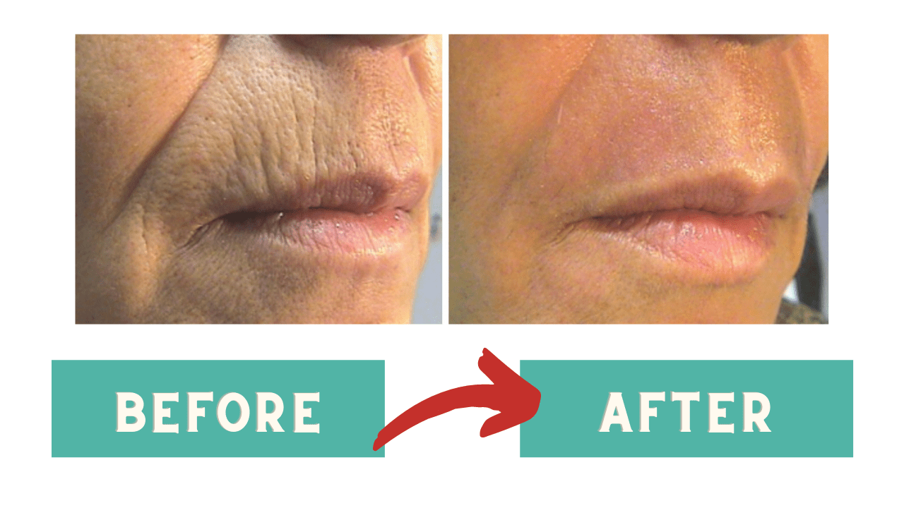 Before and after skin resurfacing with CoolPeel™ Laser, and Subnovii Plasma Pen