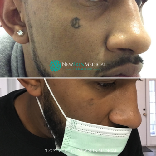 Tattoo Removal by Dr. Sherman 3 sessions