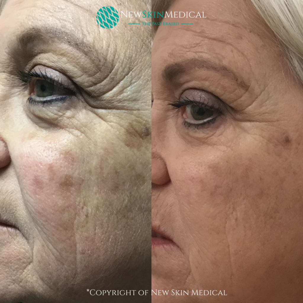 Before and after Co2 Laser skin resurfacing