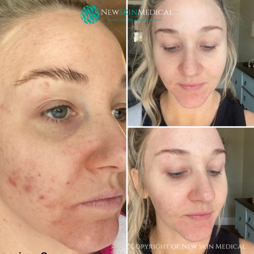 Real patient before and after Vi Peel for acne - Image Copyright of New Skin Medical Spa