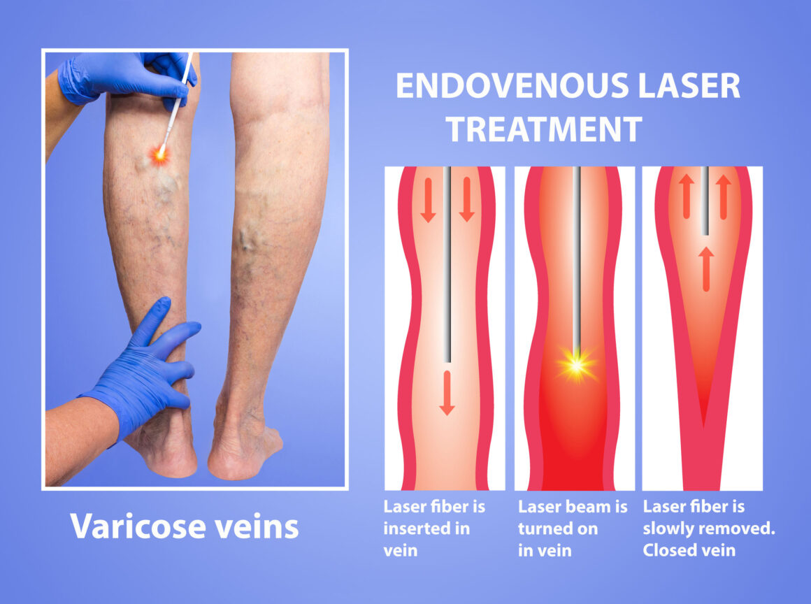 varicose veins display ad for laser treatment 