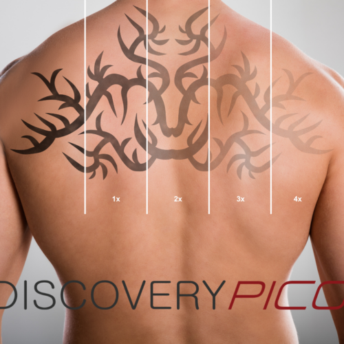 Discovery-Pico-Laser-Tattoo-Removal-Treatment