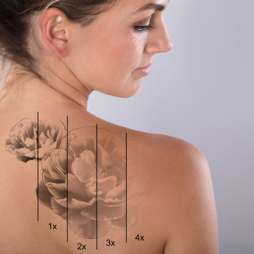 Experience the latest in Laser Tattoo Removal -Discovery pico laser