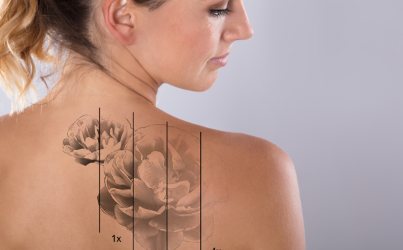 Experience the latest in Laser Tattoo Removal -Discovery pico laser