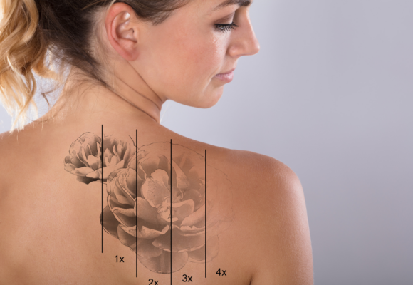 Experience the latest in Laser Tattoo Removal -Discovery pico laser