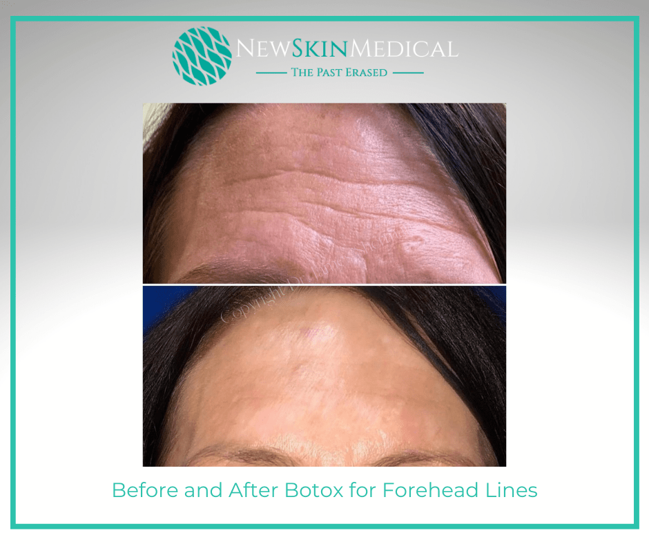 Before and After Botox for Forehead Lines with Dr. James Sherrman