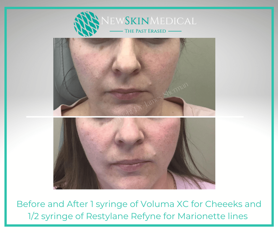 Before and After 1 syringe of Voluma XC for Cheeeks and 1/2 syringe of Restylane Refyne for Marionette lines at New Skin Medical in Augusta