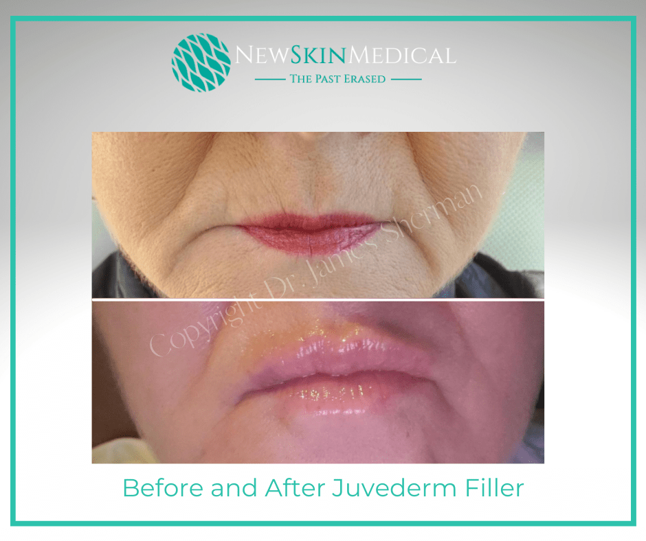 Before and after Juvederm for lips