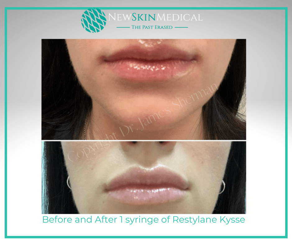 Before and after Lip Filler at New Skin Medical Spa
