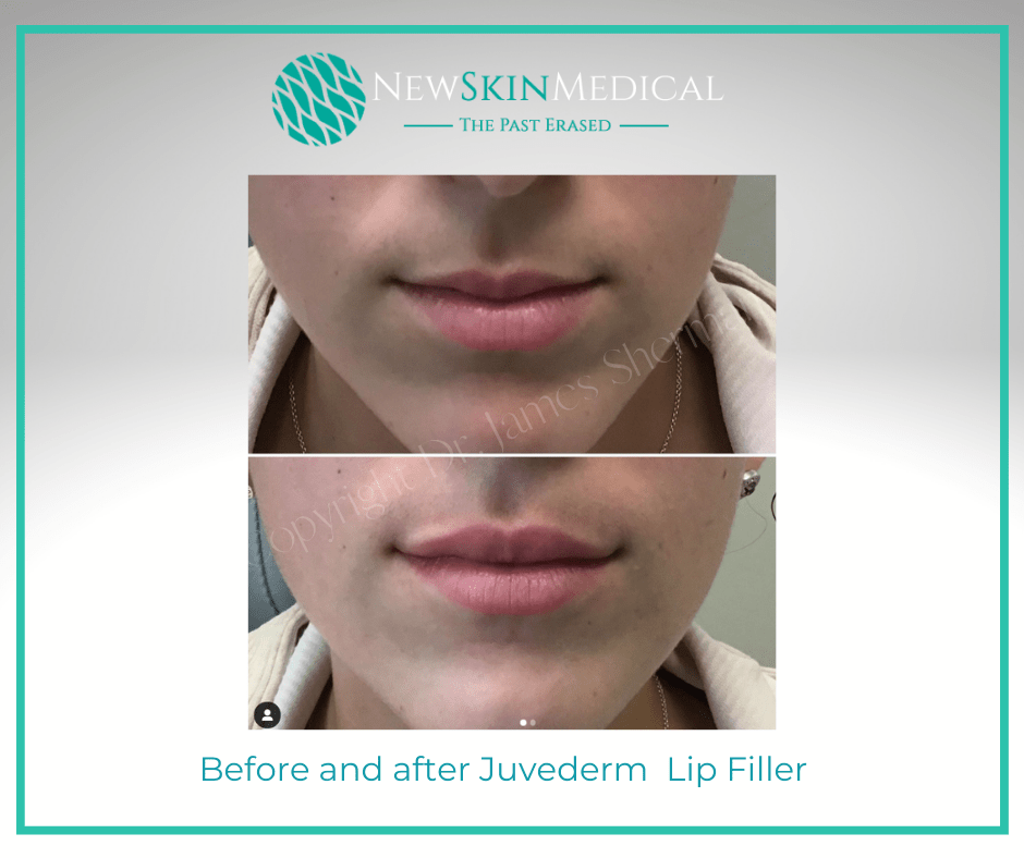 Before and after Juvederm to the lips