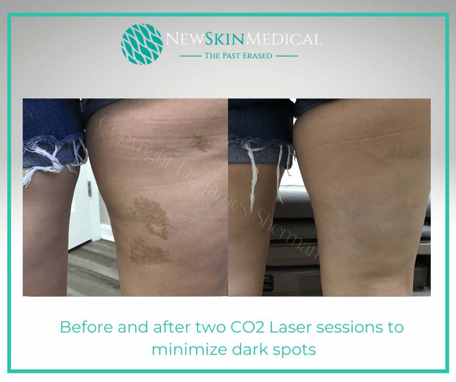 Before and after Co2 Laser for dark spots