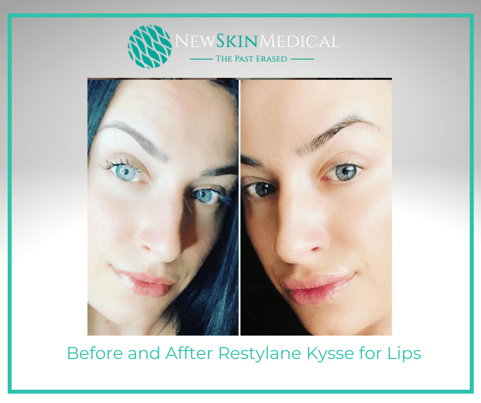 Before and after Restylane Kysse for Lips