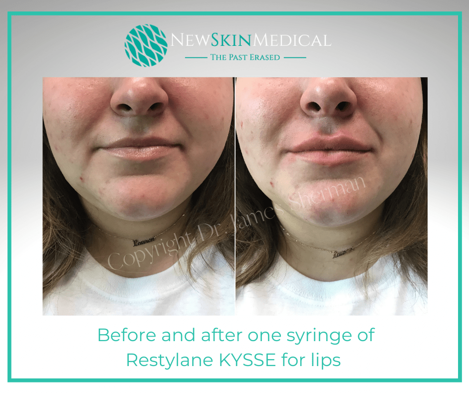 Restylane KYSSE Before and After - New Skin Medical Augusta (2)