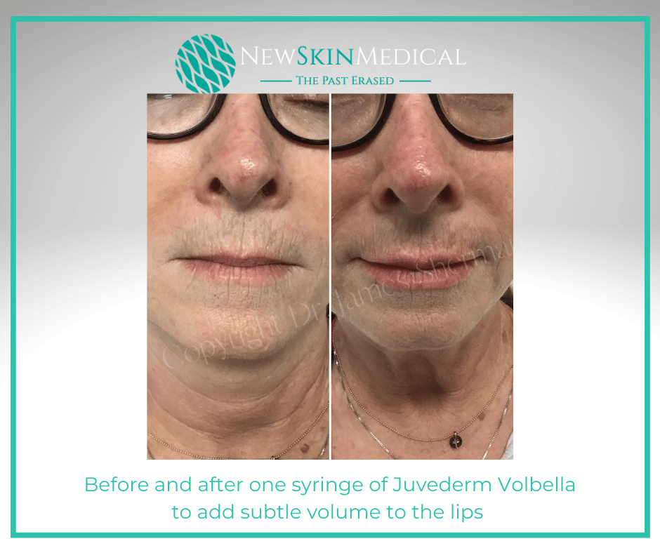 Before and after one syringe of Juvederm Volbella to add subtle volume to the lips