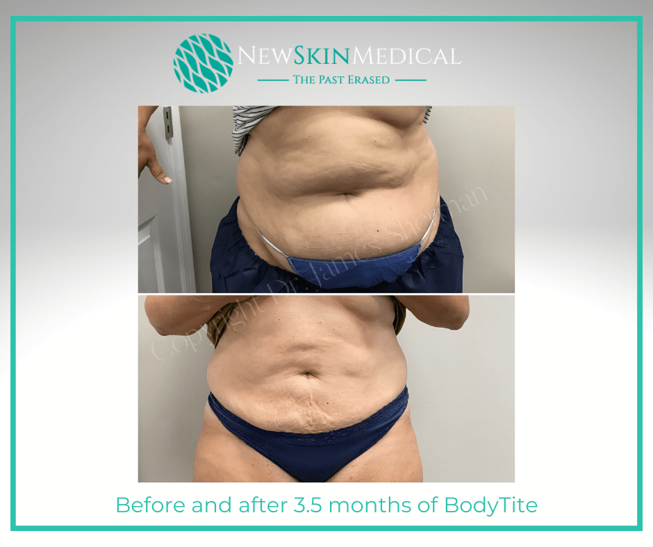 Before and after BodyTite Body Sculpting by Dr. James Sherman