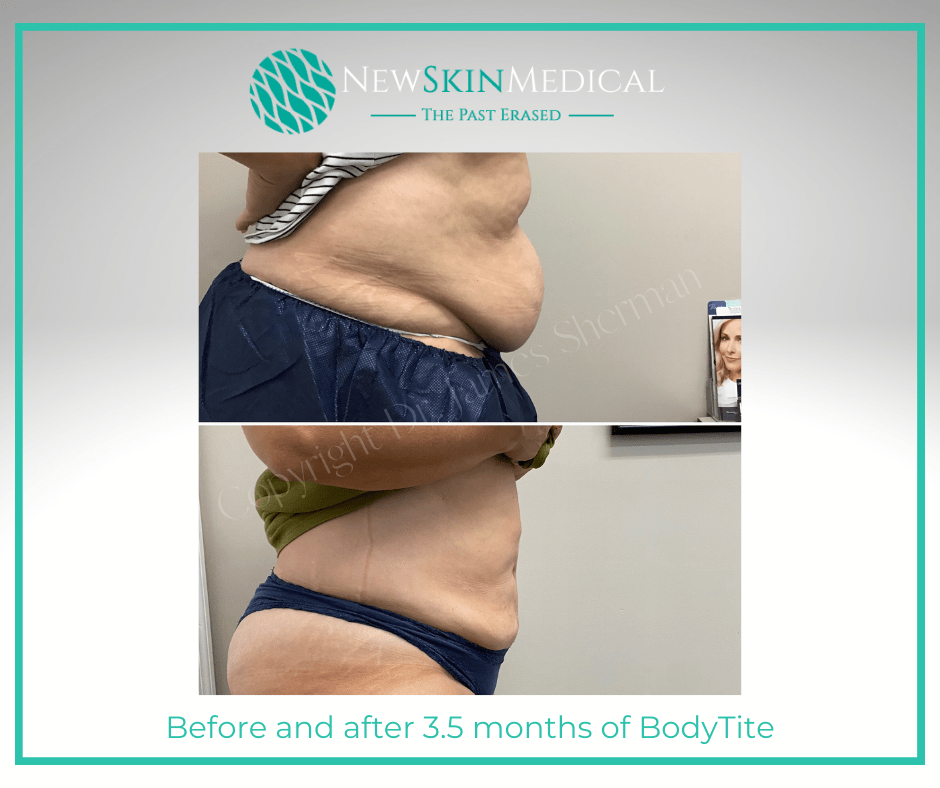 Before and after BodyTite Body Sculpting by Dr. James Sherman in Augusta Ga