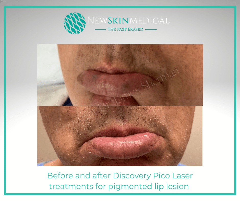 Before and after Discovery Pico Laser treatments for pigmented lip lesion by Dr. James C. Sherman.  - New Skin Medical Augusta
