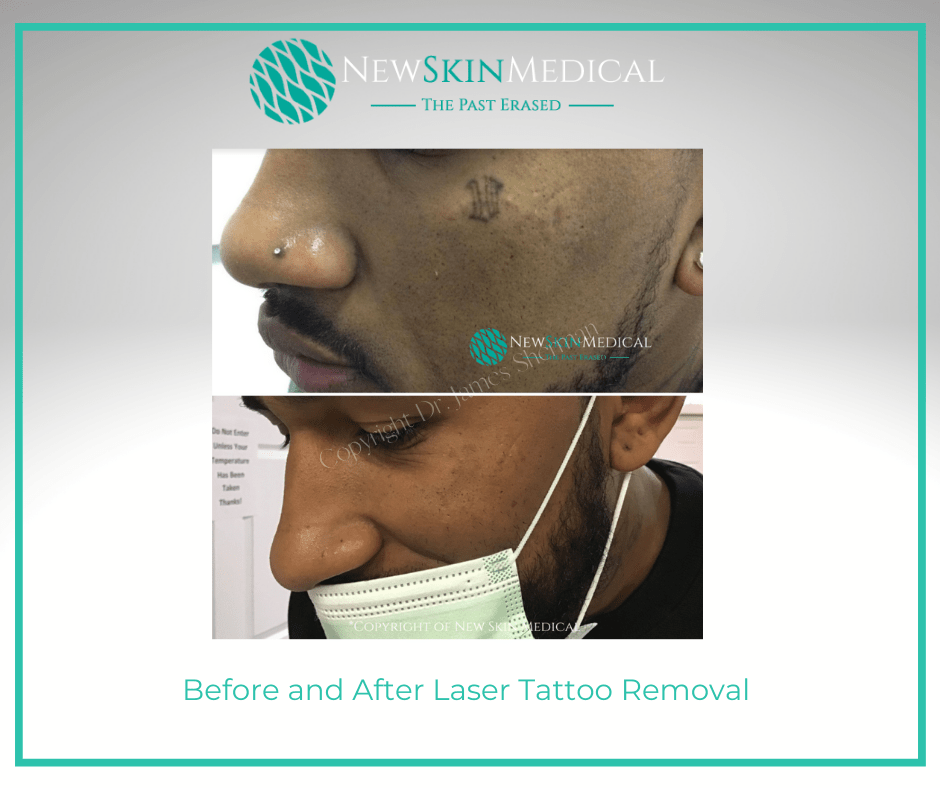 Before and After Laser Tattoo Removal with Dr. James Sherman