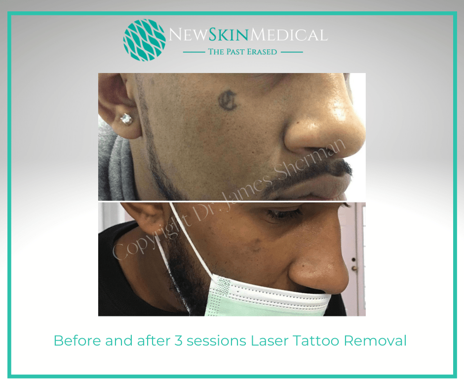 Before and After Laser Tattoo Removal with Dr. James Sherman