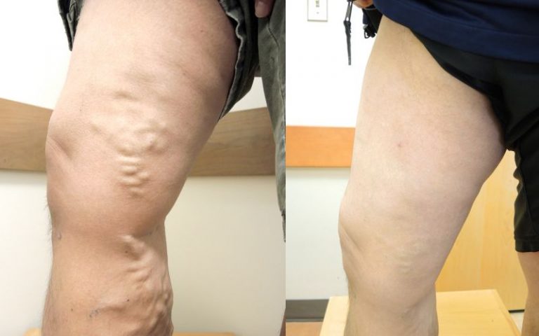 Before and after Laser Vein Treatment - TSV