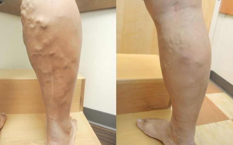 Before and After Laser Vein Procedure at Vein Specialists of Augusta Ga