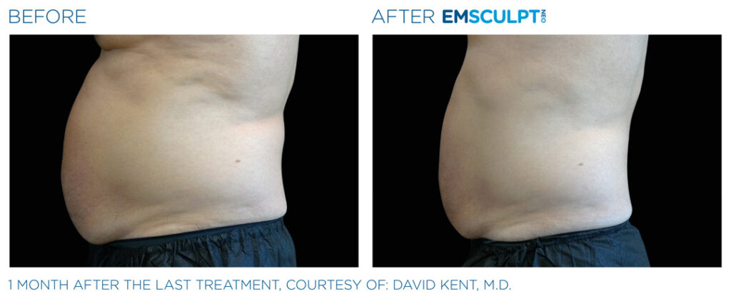 Before and After EMSculpt NEO now available at New Skin Medical
