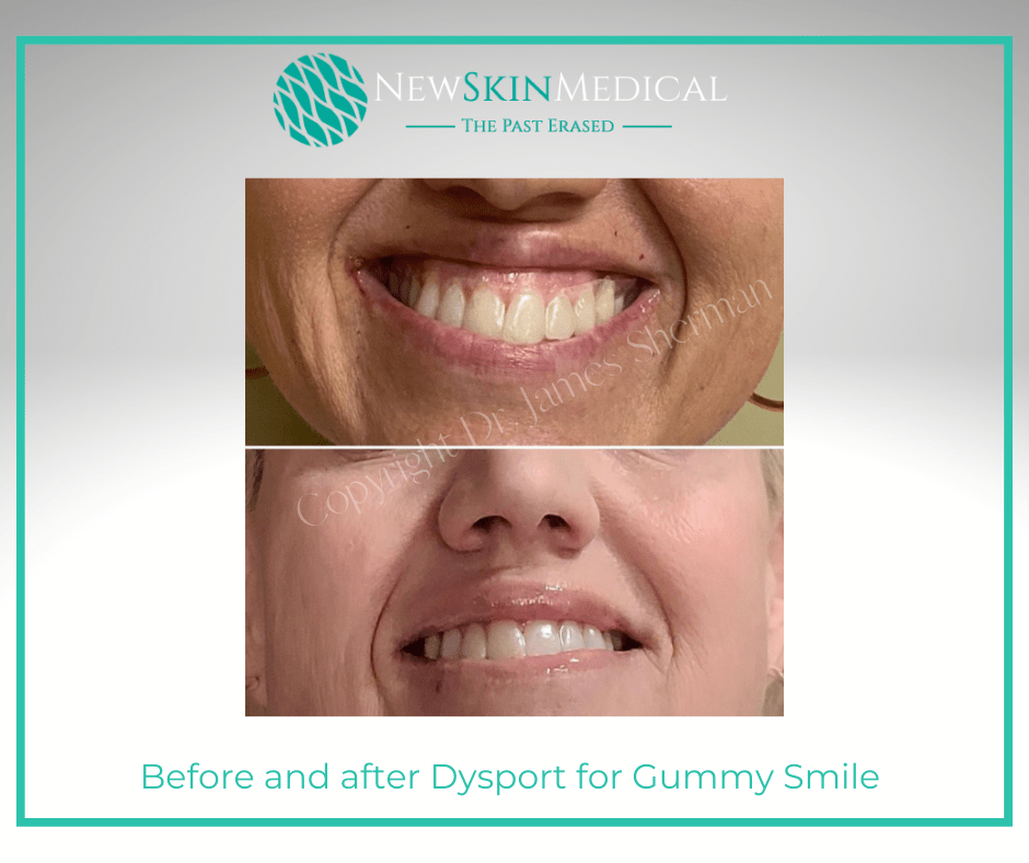 Before and after Dysport for Gummy Smile at New Skin Medical Augusta