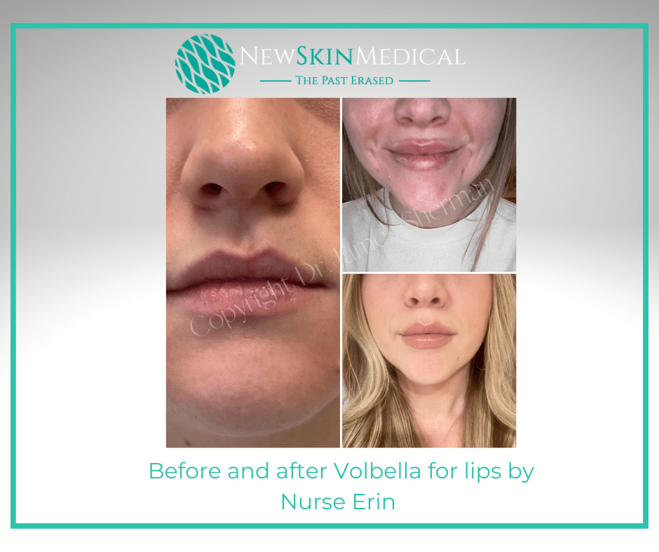 Before and after Volbella for Lips with Nurse Erin at New Skin Medical Augusta
