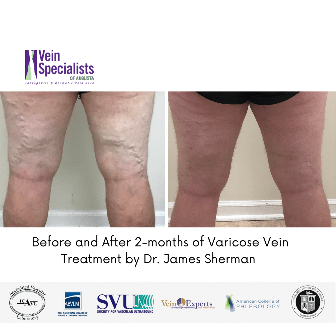 Before and After 2-months of Varicose Vein Treatment by Dr. James Sherman