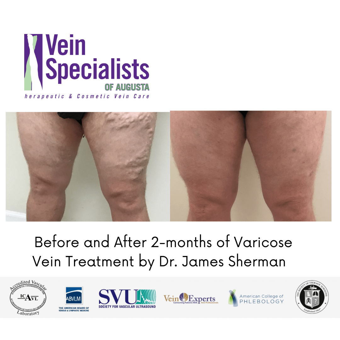 Before and After 2-months of Varicose Vein Treatment by Dr. James Sherman