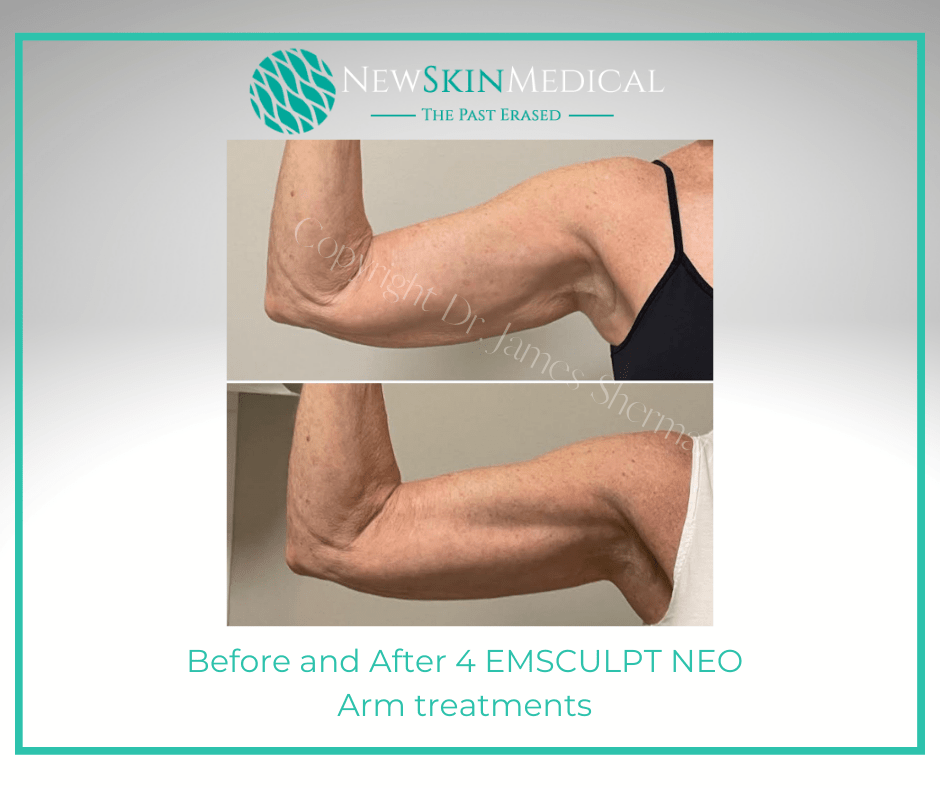 Before and After 4 EMSCULPT NEO Arm treatments  - Newskin Medical Spa