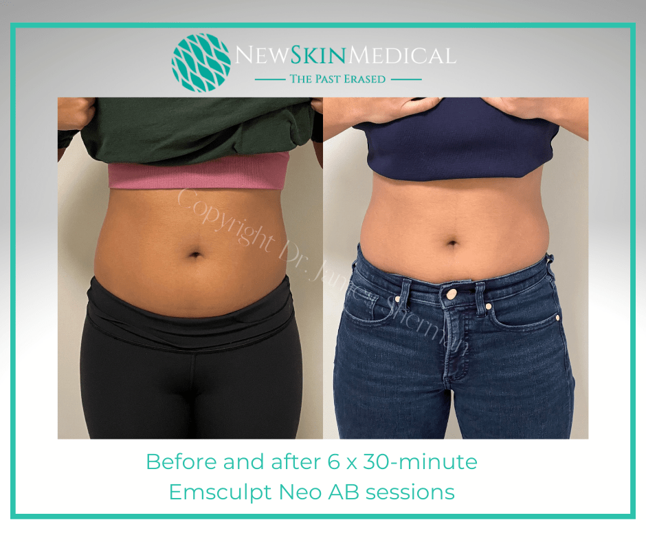 Before and after 6 x 30-minute Emsculpt Neo AB sessions -New Skin Medical Spa