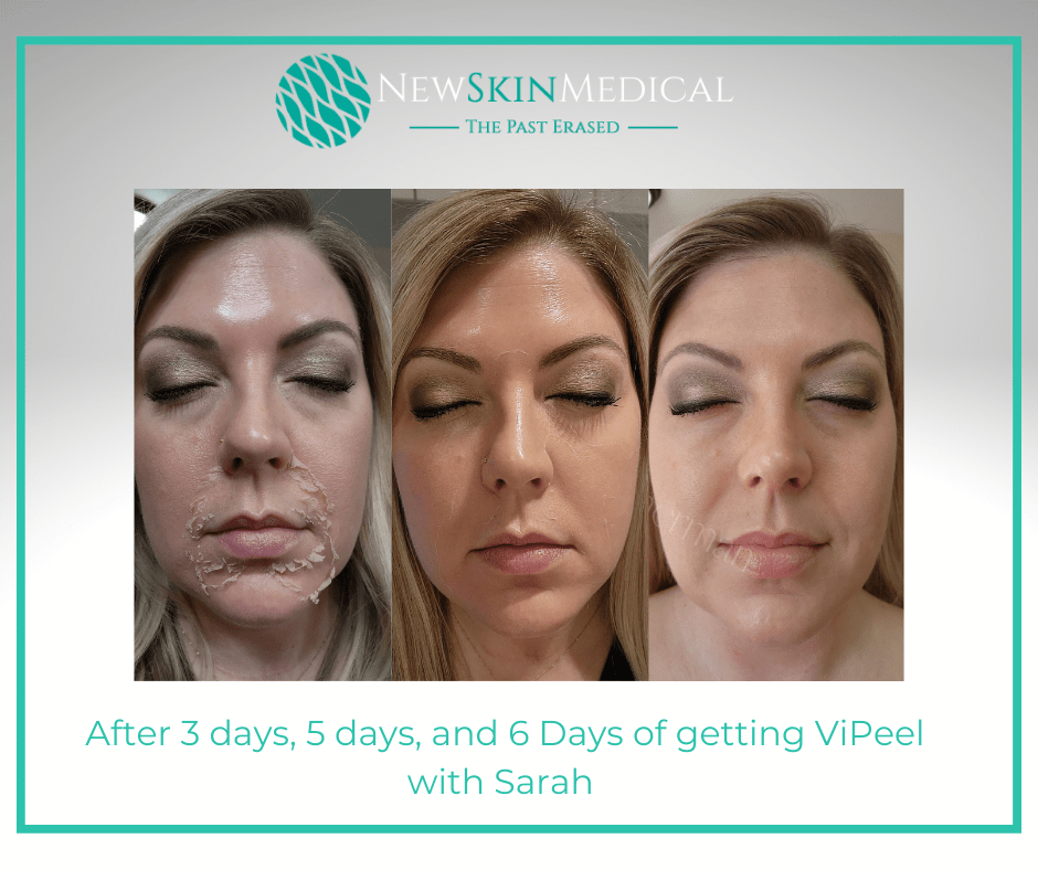 After 3 days, 5 days, and 6 Days of getting ViPeel with Sarah -New Skin Medical Spa