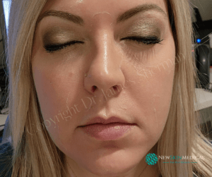 After 5 Days of getting ViPeel with Sarah -New Skin Medical Spa