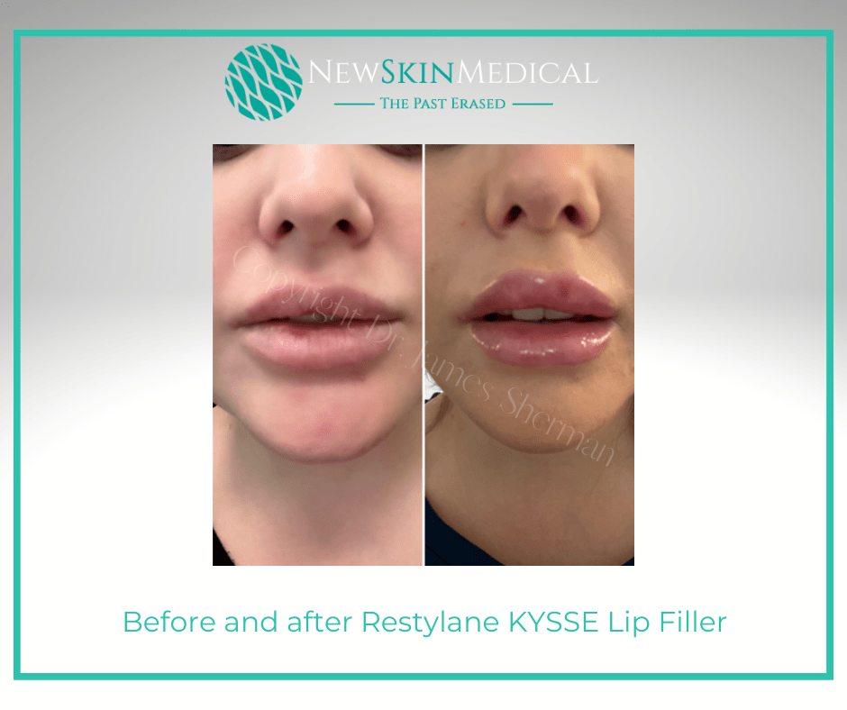 Before and after Restylane KYSSE Lip Filler