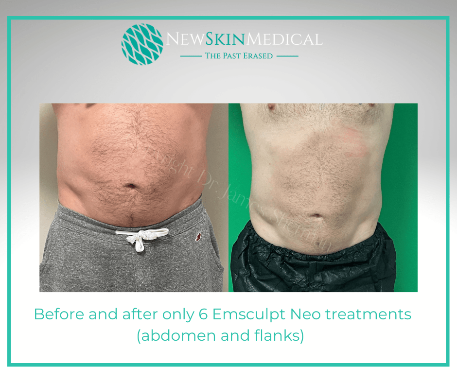 Before and after only 6 Emsculpt Neo treatments (abdomen and flanks) at New Skin Medical Spa Augusta