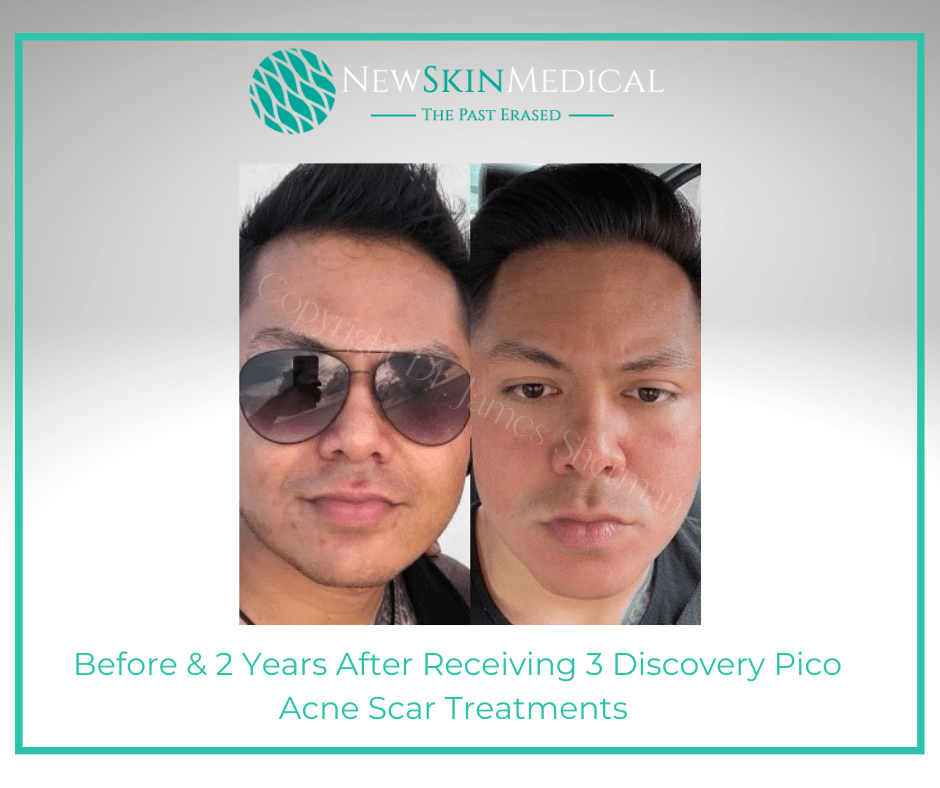 Before & 2 Years After Receiving 3 Discovery Pico Acne Scar Treatments -New Skin Medical Spa (4)