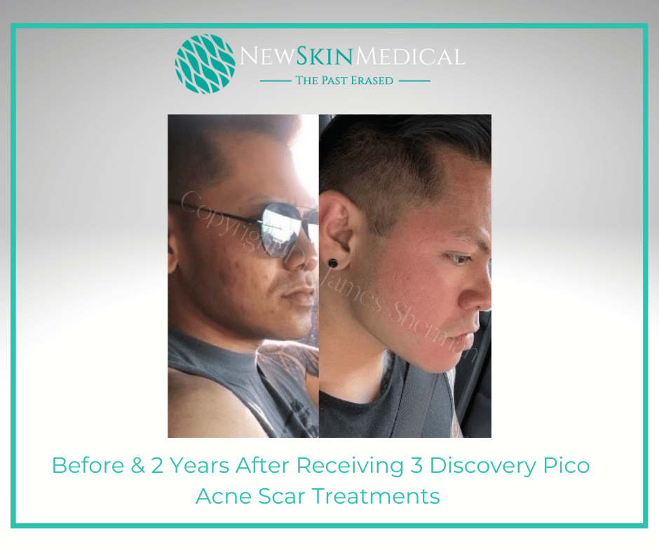 Before & 2 Years After Receiving 3 Discovery Pico Acne Scar Treatments -New Skin Medical Spa (4)