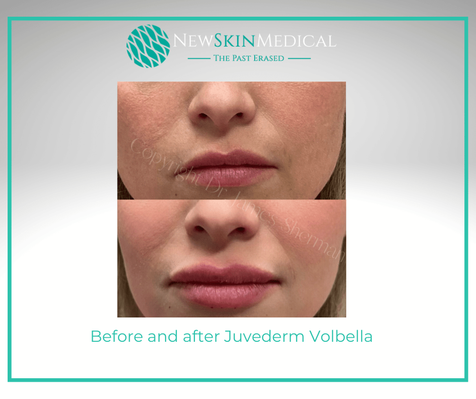 Before and after Juvederm Volbella by Nurse Erin -New Skin Medical Spa
