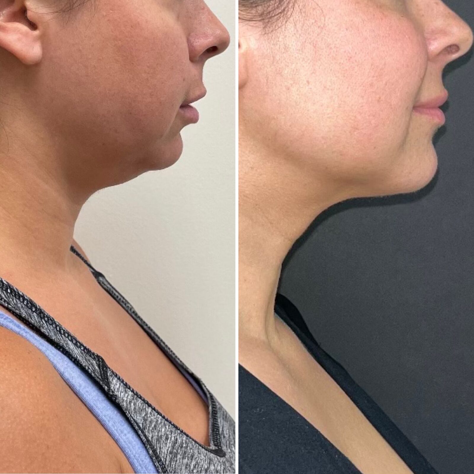 Before and after 1-month of FaceTite by Dr. James Sherman *Copyright New Skin Medical Spa