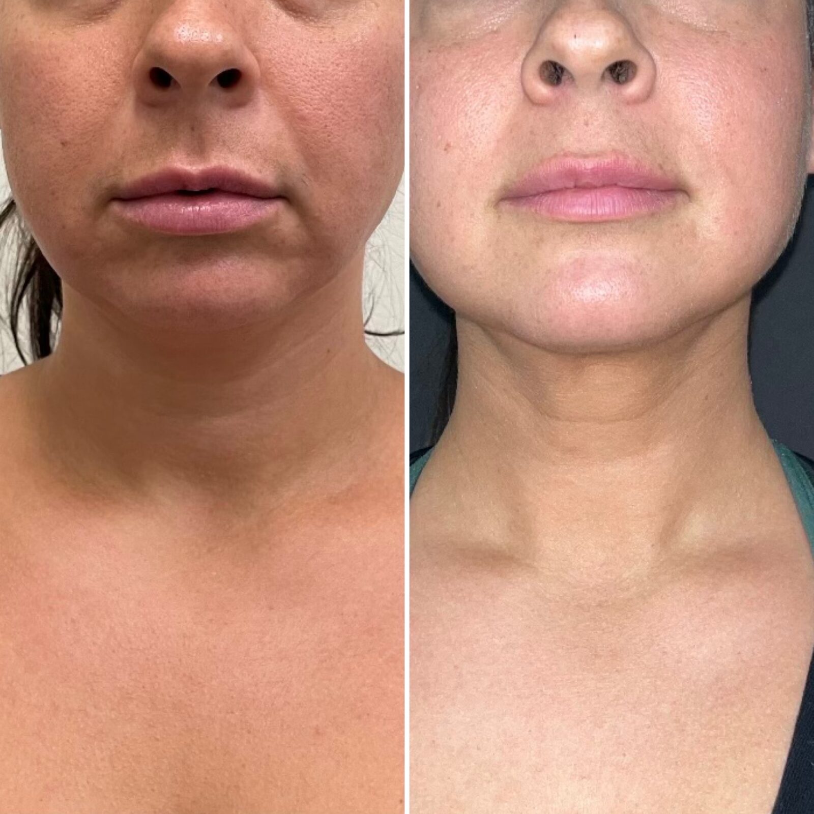 before and after 1 month of facetite front view