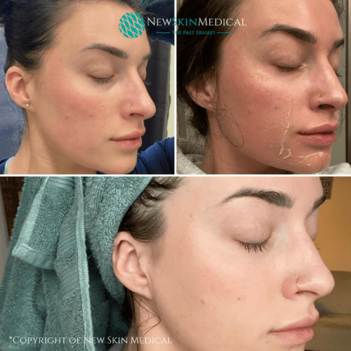 Real patient before and after 1 Vi Peel to refresh skin and to reduce redness. Before and after 3 days, and after 10 days