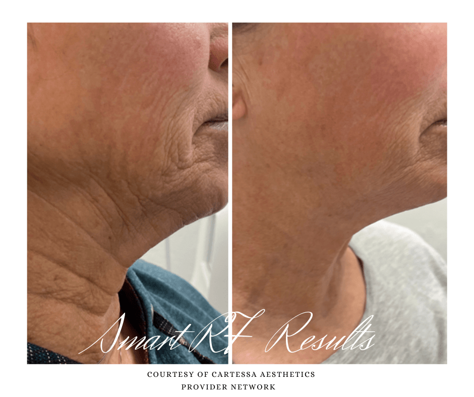 Saggy skin treatment result with Virtue RF - Smart RF