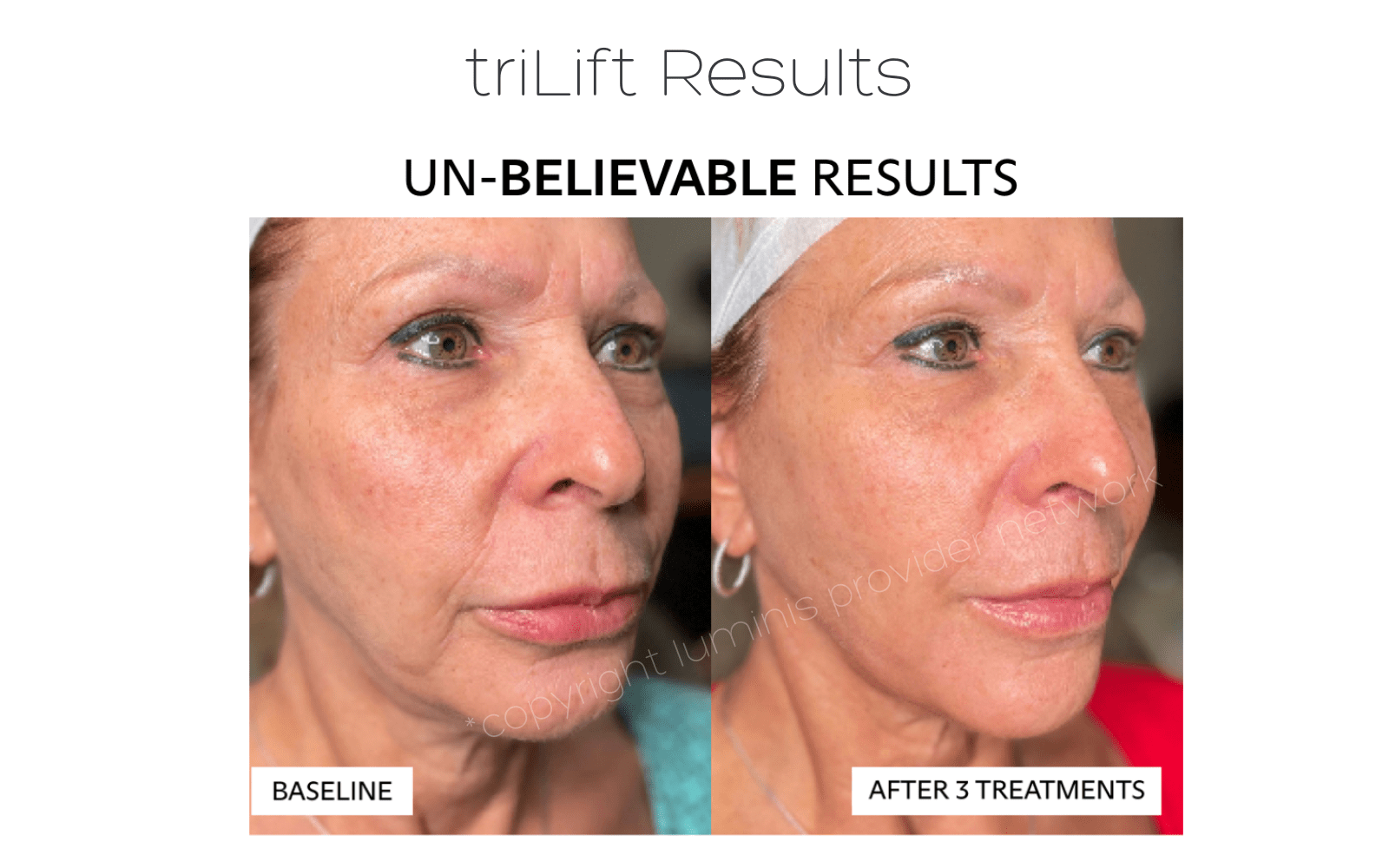 triLift results before and after three treatments for facial sagging