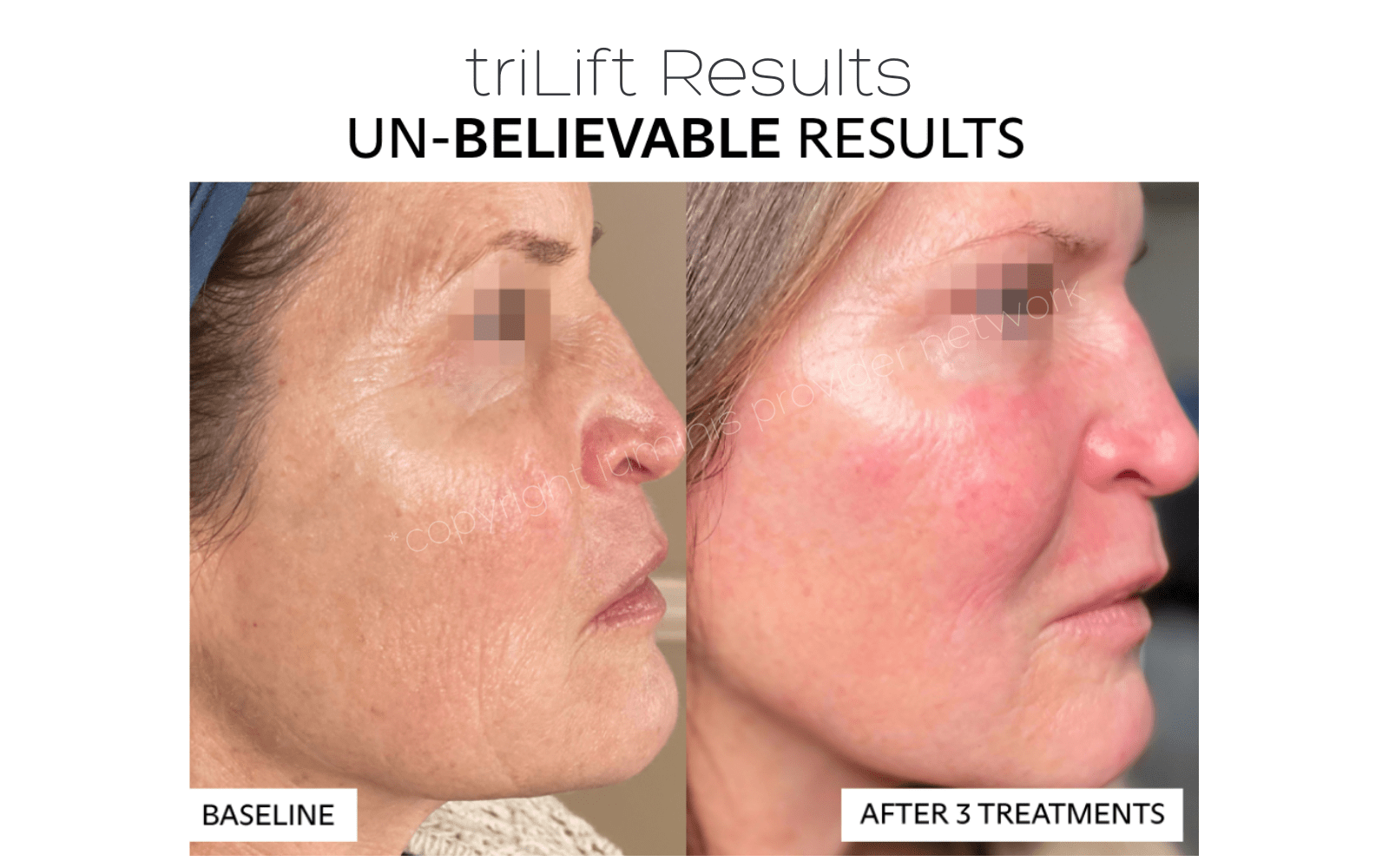 triLift results before and after 3 treatments