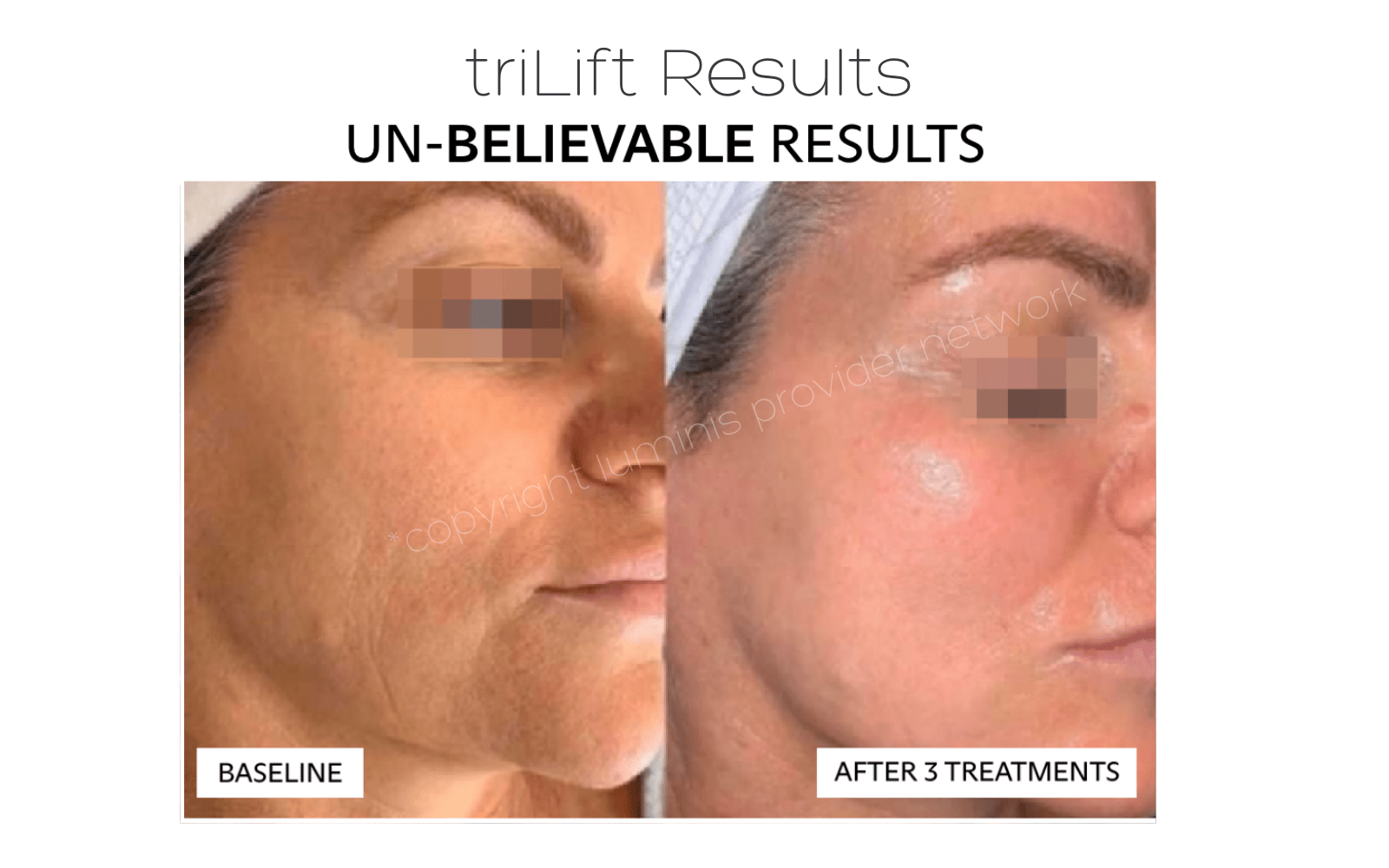image shows patient side view before and after the triLift facelift. The treatment helps to restore facial tone and volume and lifts saggy skin. stimulate muscle tone with triLift at New Skin Medical Spa in Augusta GA